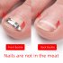 Ingrown Paronychia Metal Toenail Pedicure  Tool Straightening Correction Clip Curved Brace Suitable For Professional Home Use 3pcs set