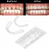 Dental Dentures Modified Temporary Teeth Homemade Dentures Missing Teeth Whitening Teeth CMaterials Denture Care Braces   filling gum