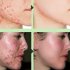 Facial Cream Whitening Moisturizing Shrinking Face Acne Removal Cream Acne Relief Cream 20g