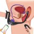 Telescopic Vibrating Butt Plug Anal Vibrator Wireless Cock Penis Ring Green Remote Control Model