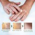 US Vitiligo Leukoplakia Disease Treatment Ointment White Spot Disease Repair Cream Pigment Melanin Balm 20g