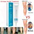 Varicose Veins Ointment Vasculitis Treatment Phlebitis Angiitis Inflammation Blood Vessel Rotten Legs Varicose Veins Cream