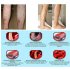 Varicose Veins Ointment Vasculitis Treatment Phlebitis Angiitis Inflammation Blood Vessel Rotten Legs Varicose Veins Cream